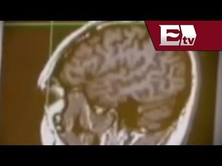 Terapia electroconvulsiva, ¿En que consiste el tratamiento?  (Reportaje especial) / Salud