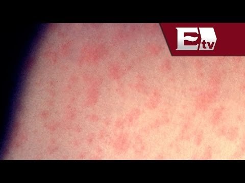 Vacunarse contra el Sarampión: autoridades de salud en México/ Salud con Gloria Contreras