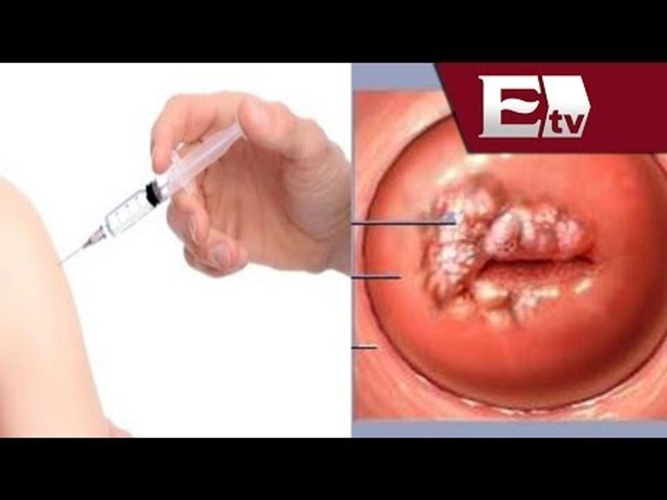 Vacuna del Virus de Papiloma Humano  / Salud con Gloria Contreras