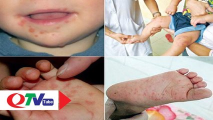 Cẩn trọng với bệnh tay - chân - miệng - QTV