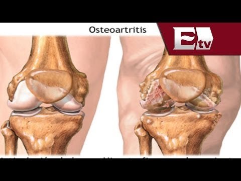 Osteoartritis afecta al 30% de la población / Salud