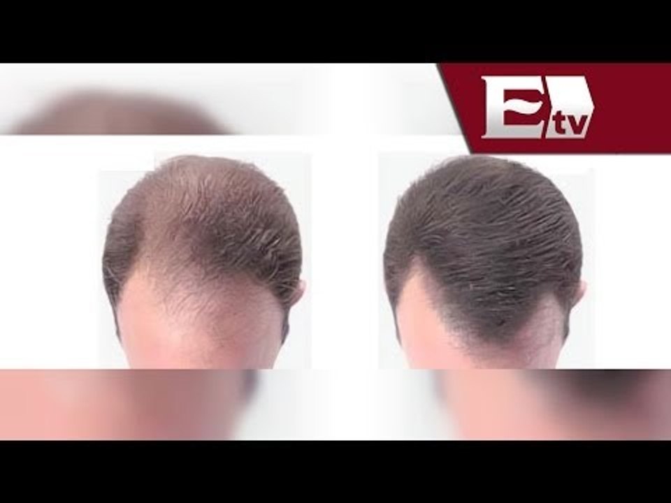 ¿Qué son los tratamientos capilares sin cirugía? / Titulares con Vianey Esquinca