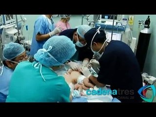 Separan a siamesas peruanas que compartían el hígado