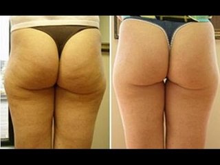 ¿Se puede quitar o disminuir la celulitis? / Did I could remove or reduce cellulite?