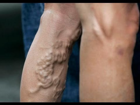 ¿Por qué salen las várices? / Cómo evitar que salgan várices