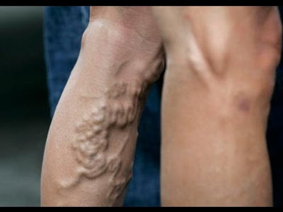 ¿Por qué salen las várices? / Cómo evitar que salgan várices