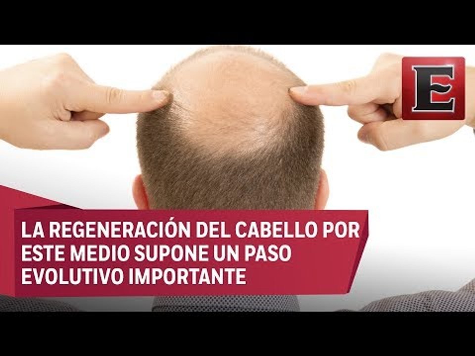 ¿Cómo combatir la alopecia con células madre?