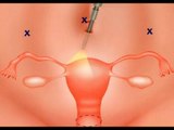 Cómo evitar los quistes ováricos