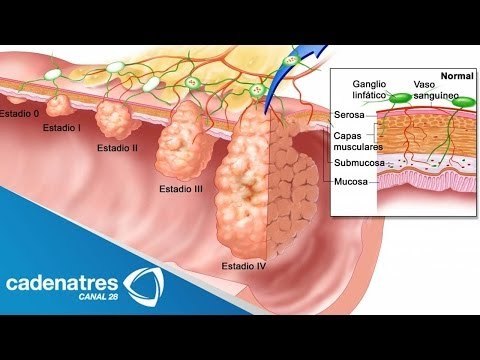Científicos de Australia descubren interruptor genético contra la metástasis