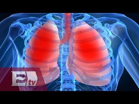 ¿Qué es la hipertensión pulmonar? / Salud