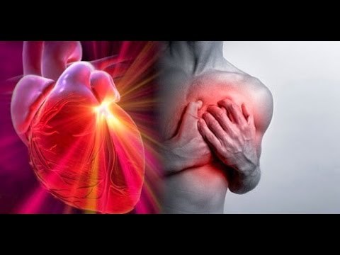 ¿Qué es un infarto agudo al miocardio?