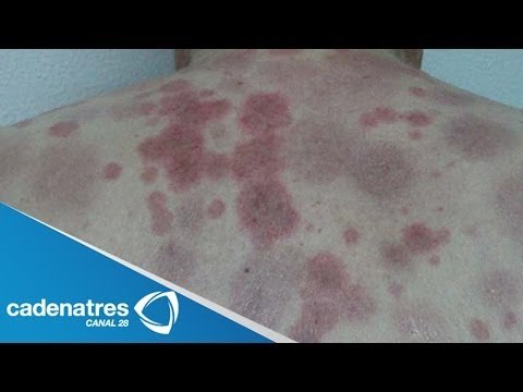 Síndrome mielodisplásico sintomas / ¿ Qué es el síndrome mielodisplásico?