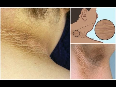 Remedios caseros para desmanchar axilas, rodillas y codos