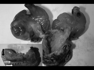 Bebé nace embarazada de gemelos/ Las 5 maravillas del día