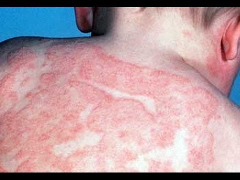 ¿Cómo cuidarte de la Dermatitis atópica?