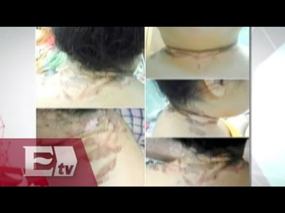 Yucateca sufre quemaduras al utilizar su celular mientras se cargaba / Vianey Esquinca