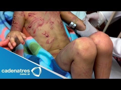 Autoridades investigan quemaduras de genitales de un menor de 5 años en Edomex