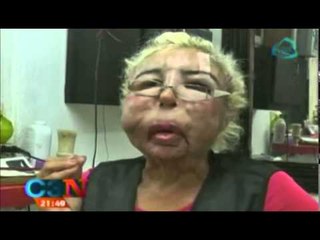 ¡¡INCREÍBLE!! Hombre se inyecta aceite de bebé y se deforma el rostro