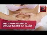 Lo que necesitas saber sobre la miomatosis uterina