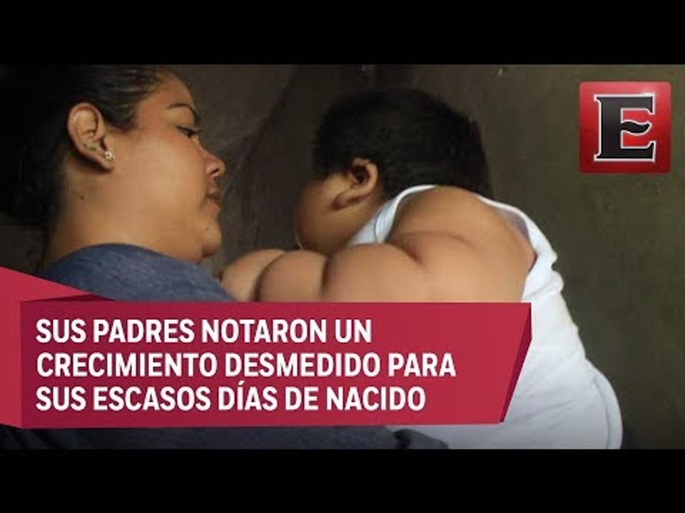 Bebé de 10 meses pesa 30 kilos, podría tener Síndrome de Prader-Willi