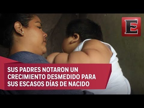 Bebé de 10 meses pesa 30 kilos, podría tener Síndrome de Prader-Willi