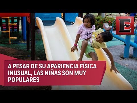 Pan y Pin, las siamesas que no quieren ser separadas