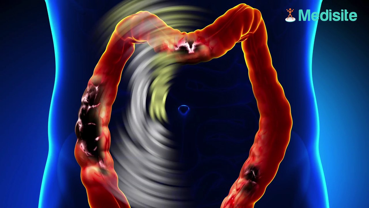 Helicobacter Pylori : la bactérie aussi responsable du cancer du côlon ?