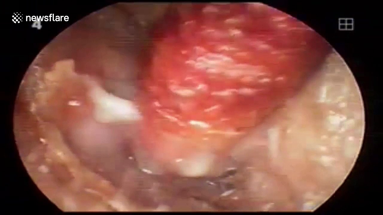 This man had a giant pimple buried deep in his ear canal