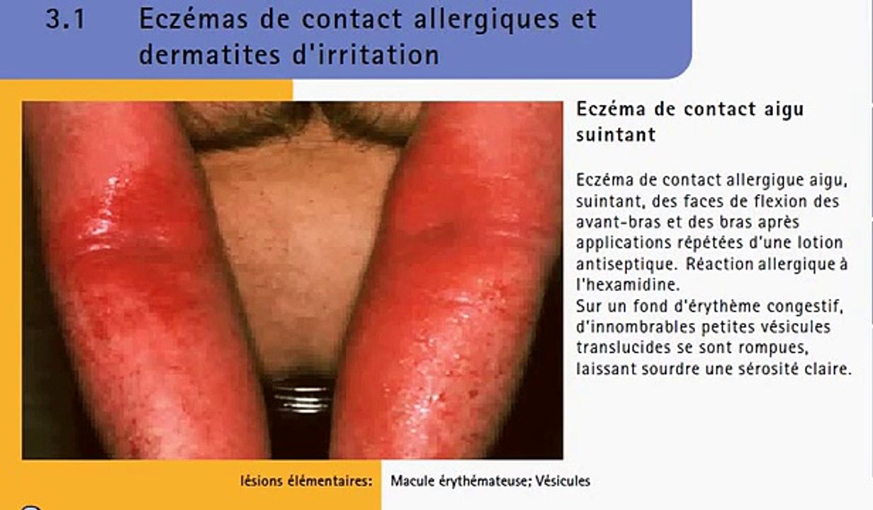 Eczéma de contact - Aspect clinique et Traitement