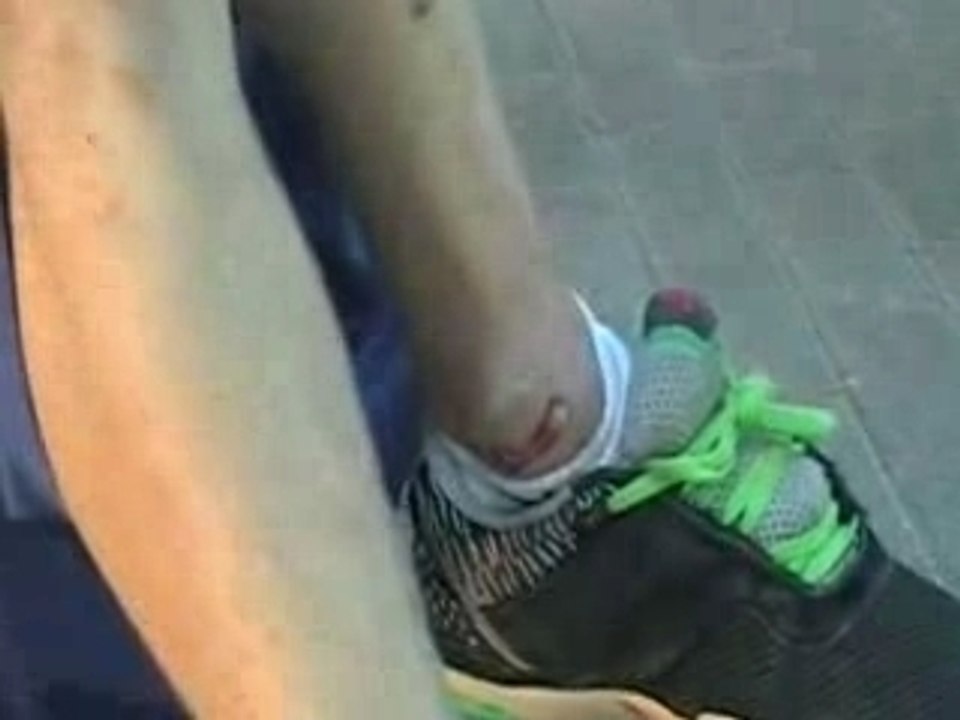Scarred mtv