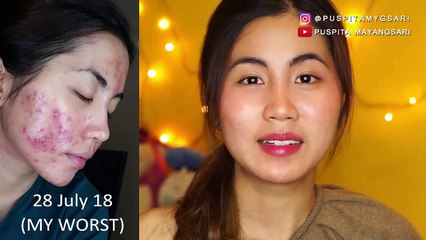 Bedak untuk kulit berjerawat dan berminyak