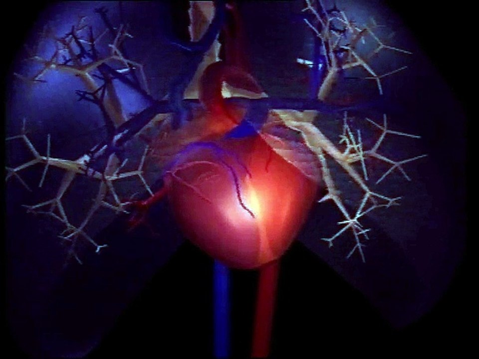 Infarctus