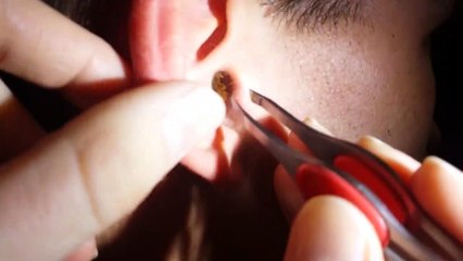 Il avait un énorme un bouchon de cérumen dans son oreille
