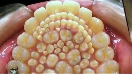 How to Pull 252 teeth In One Mouth, too Many To Extract By the Dentist