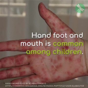 What a Mom Wished She Knew: How to Protect Your Child from Hand Foot and Mouth Disease