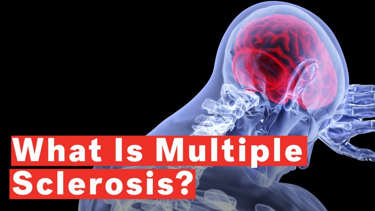 What Is Multiple Sclerosis?