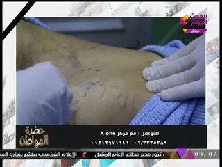 بالفيديو| د. عادل الفرجاني يشرح طريقة سحرية لعلاج "دوالي الساقين" بـ"الأوزون"