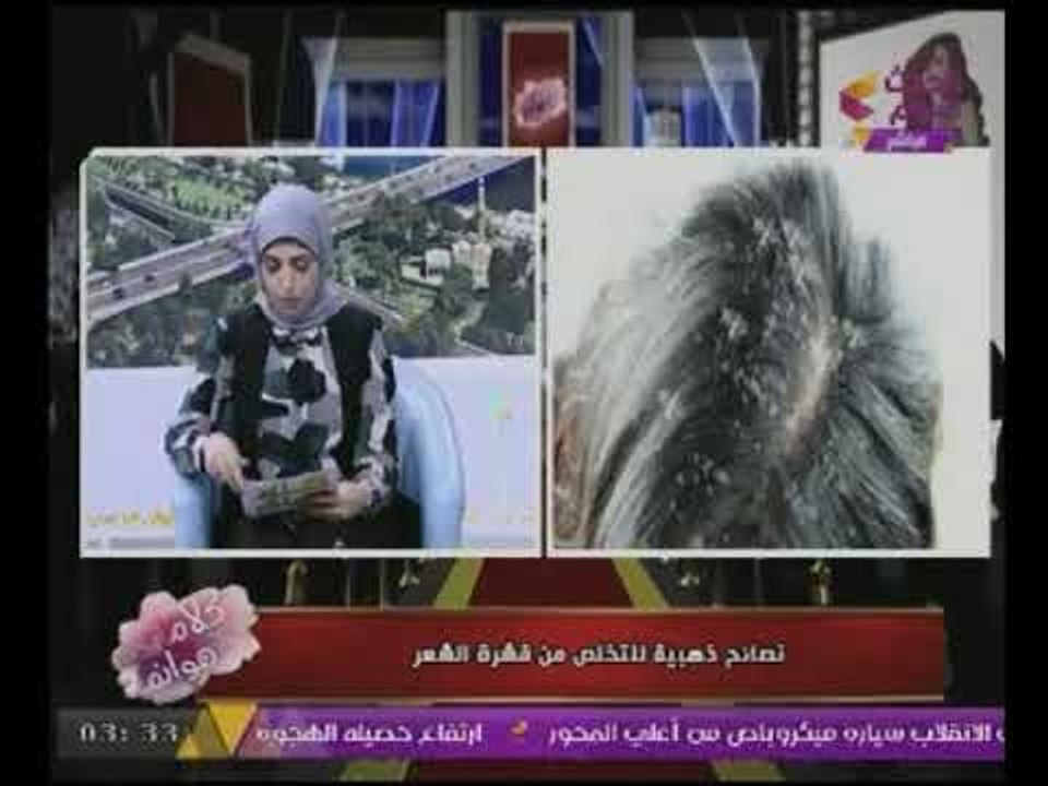 #بالفيديو : نصائح ذهبية للتخلص من "قشرة الشعر"