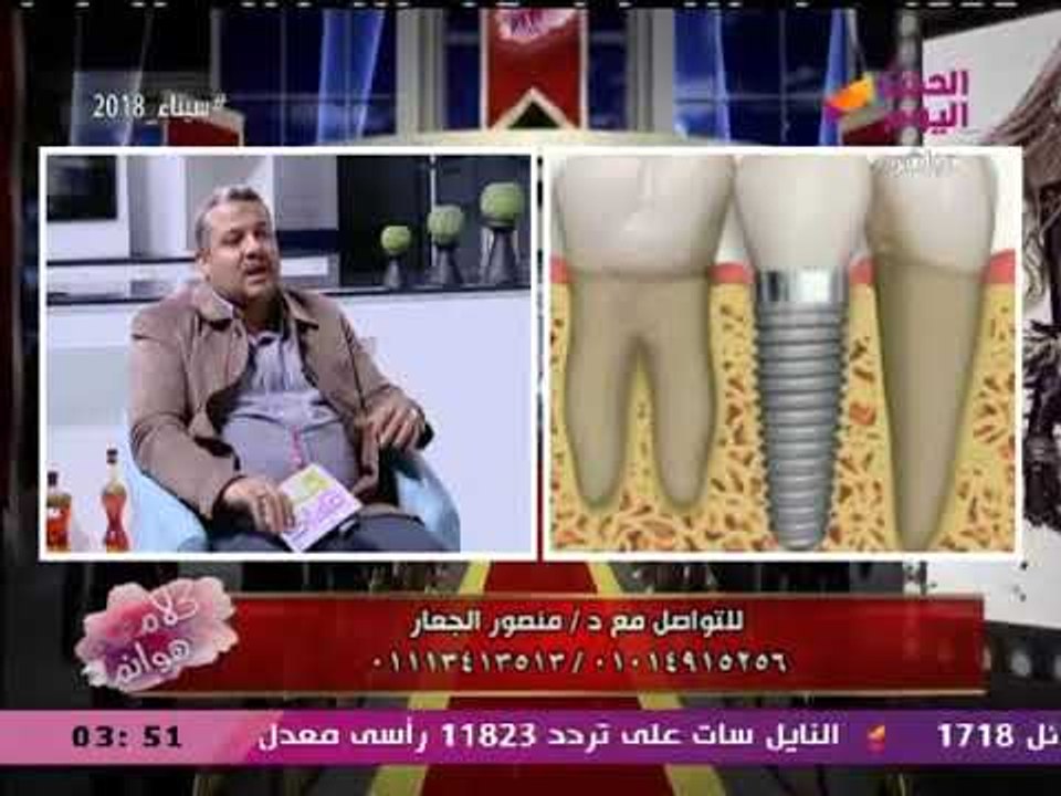 د. منصور الجعار يكشف الأنواع المختلفة للأسنان التي يتم تركيبها