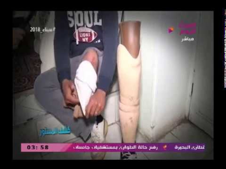 كاميرا "كشف المستور" ترصد معاناة شاب بتر قدمه بسبب خطأ طبي