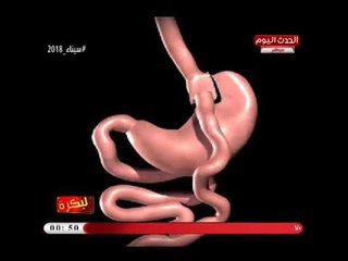 لبكرة مع شيرين شوقي|مع د.حمد عثمان استشاري السمنة وجراحة المناظير 18-4-2018