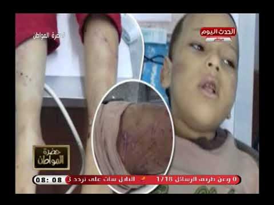 بالصور (+18):أم تعذب طفلها بإطفاء سجائر فى جسده لمشاهدته اخته فى اوضاع مخلة وتعليق ناري من سيد علي