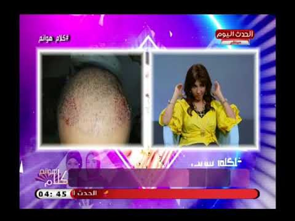 د. ولاء ابو الحجاج استشاري التجميل والليزر توضح أحدث طرق زراعة الشعر بدون جراحة