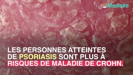 Le psorasis associé  à un risque de maladie de Crohn supérieur