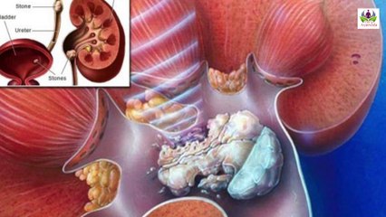 कैसे हम जानेंगे की पेट में पथरी हुआ है जानिए इसका अनेक लक्षण  | Den Tv Ayurveda