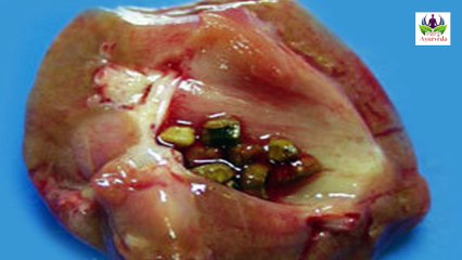 पथरी का सबसे असरदार घरेलु रामबाण उपाय । जो 2 दिन में पूरी तरह समाप्त करे । Den Tv Ayurveda