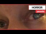 Mom left blinded after parasite latches to her eye | SWNS TV