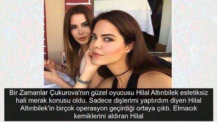 Çukurova'nın Zülayha'sı estetik harikasıymış! Hilal Altınbilek eski haline bakın
