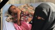 اليمن: بعد أمل حسين.. آدم علي يقضي بسبب سوء التغذية ونعي أممي 
