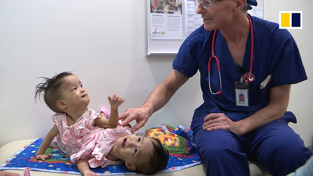 Conjoined twins successfully separated